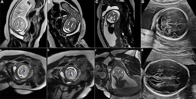 Cases report: MRI findings of asymptomatically familial subependymal heterotopia with filamin A gene abnormality